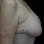 Breast Reduction Before & After Patient #19828