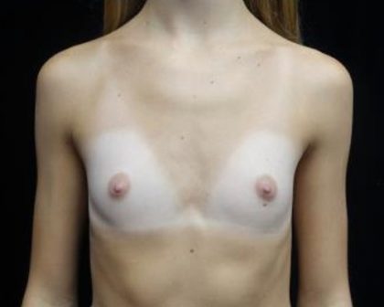 Breast Augmentation (Implants) Before & After Patient #19842