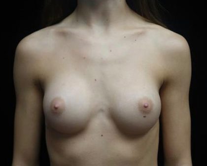 Breast Augmentation (Implants) Before & After Patient #19842