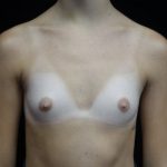 Breast Augmentation (Implants) Before & After Patient #19849