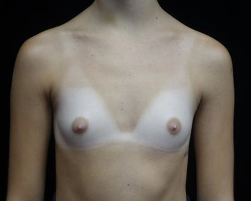 Breast Augmentation (Implants) Before & After Patient #19849