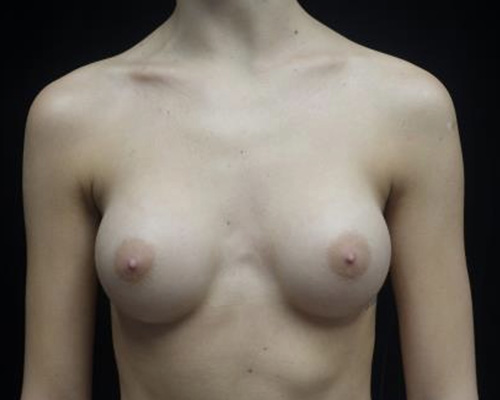 Breast Augmentation (Implants) Before & After Patient #19849