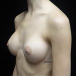 Breast Augmentation (Implants) Before & After Patient #19849