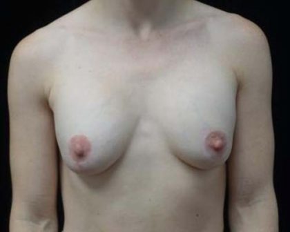 Breast Lift Before & After Patient #19805