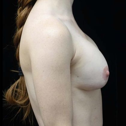Breast Lift Before & After Patient #19805