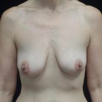 Breast Lift with Implants Before & After Patient #19916