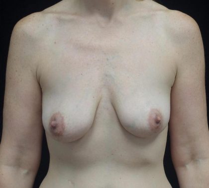 Breast Lift with Implants Before & After Patient #19916