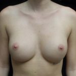 Breast Augmentation (Implants) Before & After Patient #19870