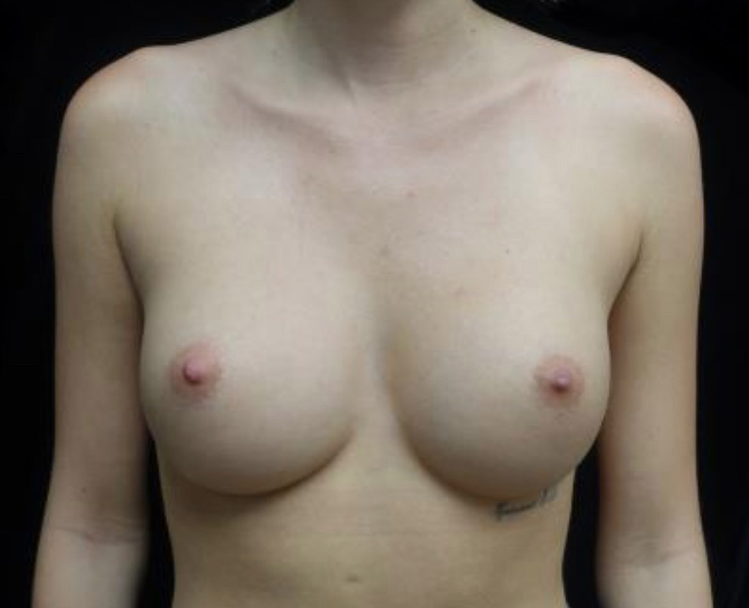 Breast Augmentation (Implants) Before & After Patient #19870