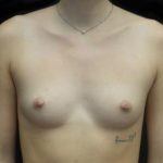 Breast Augmentation (Implants) Before & After Patient #19870