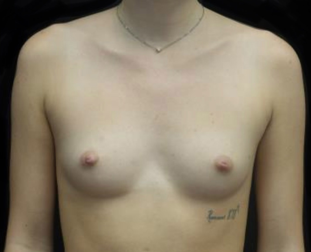 Breast Augmentation (Implants) Before & After Patient #19870