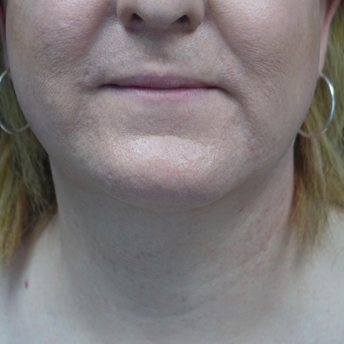 CoolMini Before & After Patient #19923