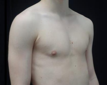 Gynecomastia Before & After Patient #19955