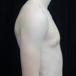 Gynecomastia Before & After Patient #19955