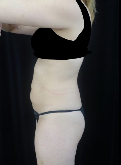 CoolSculpting Before & After Patient #20023