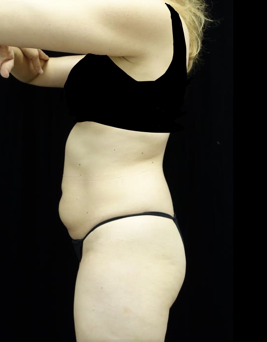 CoolSculpting Before & After Patient #20023