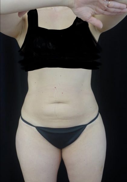 CoolSculpting Before & After Patient #20023