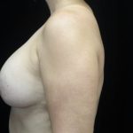 Breast Lift Before & After Patient #20047