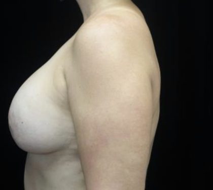 Breast Lift Before & After Patient #20047