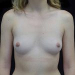 Breast Augmentation (Implants) Before & After Patient #20131