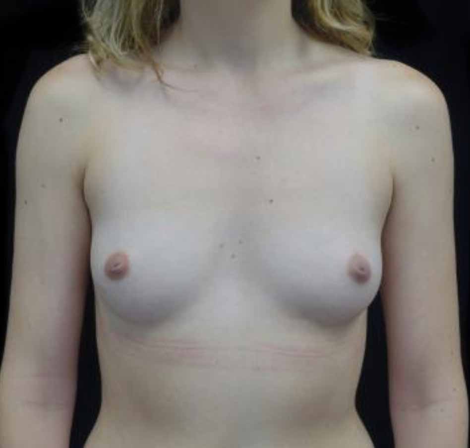Breast Augmentation (Implants) Before & After Patient #20131