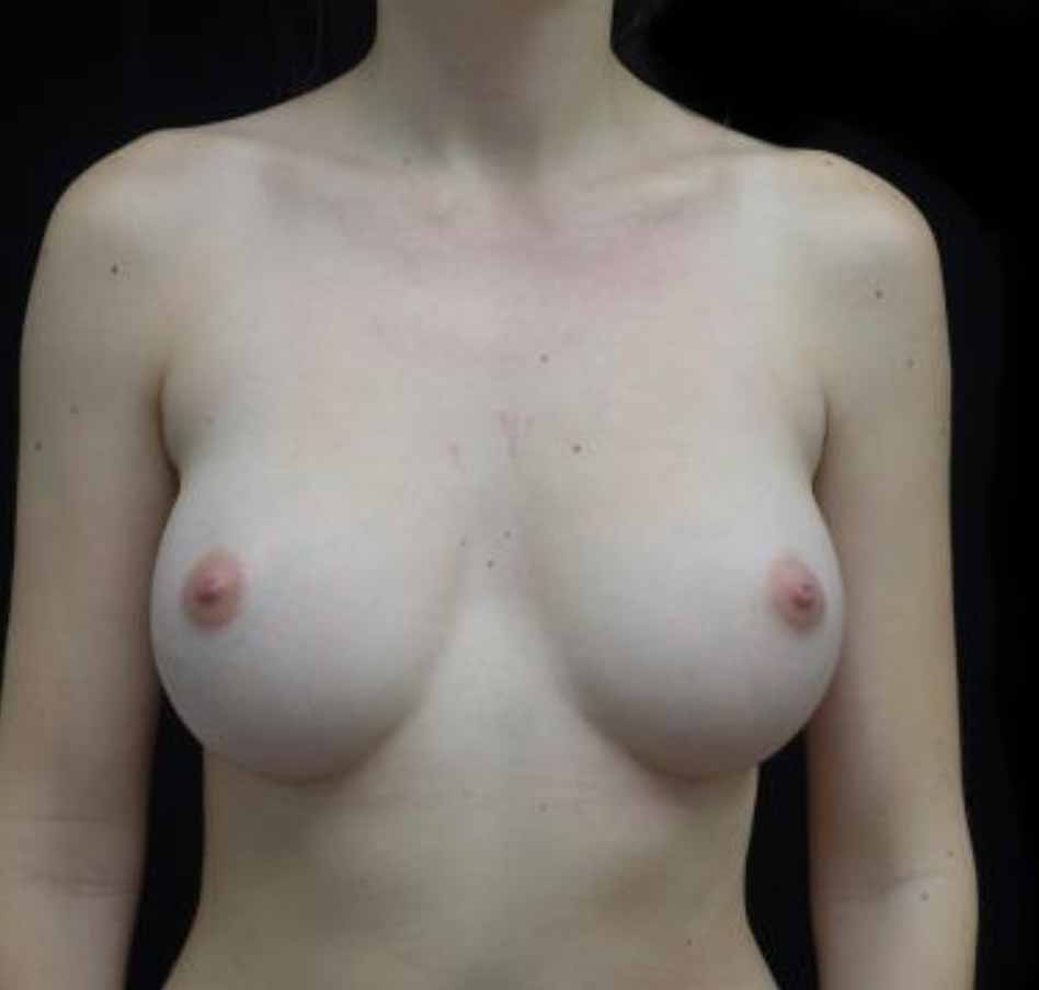 Breast Augmentation (Implants) Before & After Patient #20131