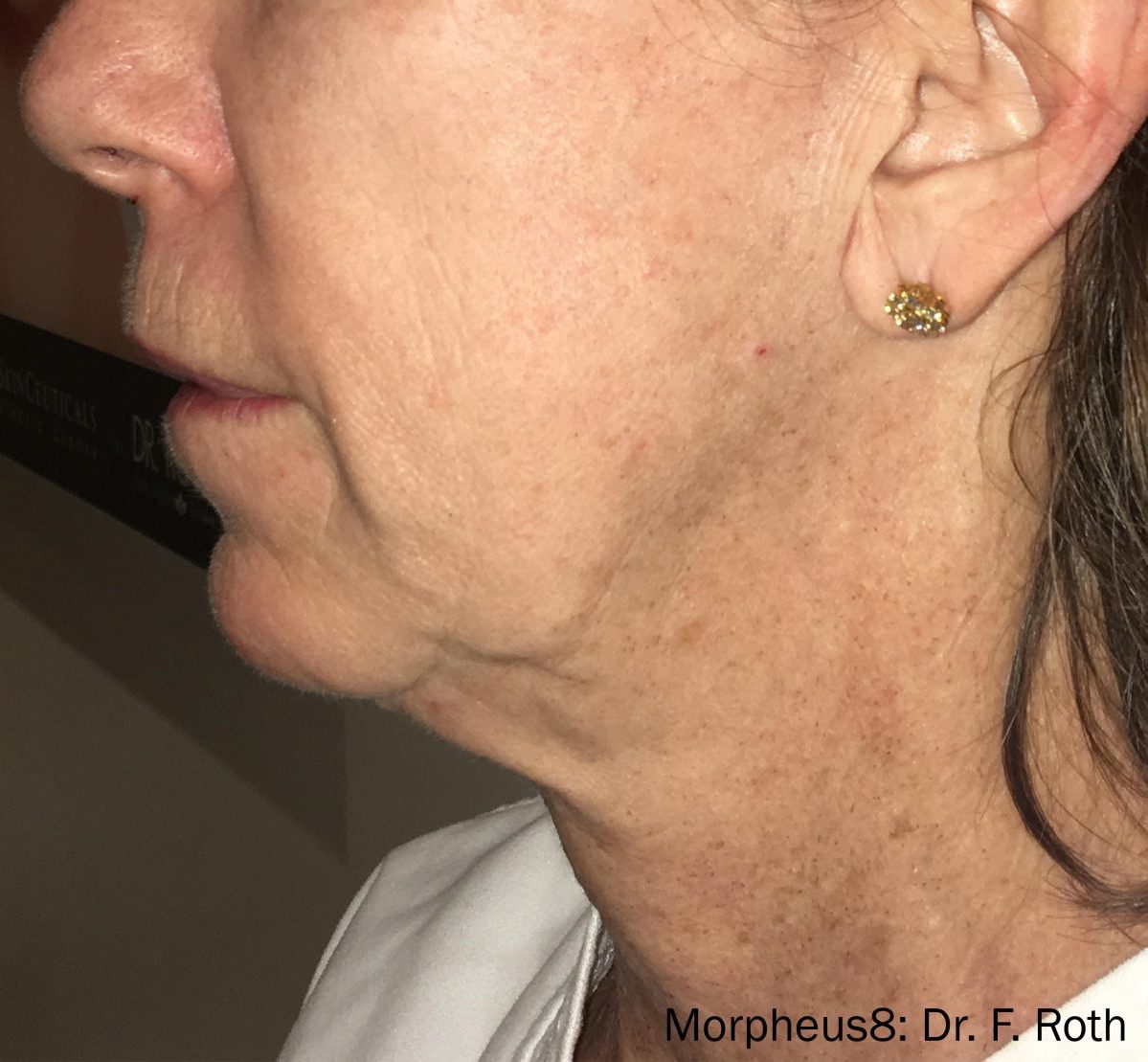 Morpheus8 Before & After Patient #20075