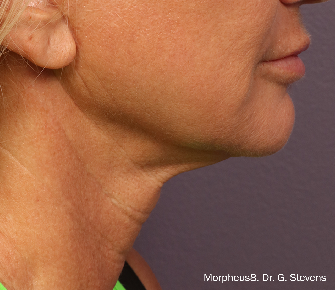 Morpheus8 Before & After Patient #20078