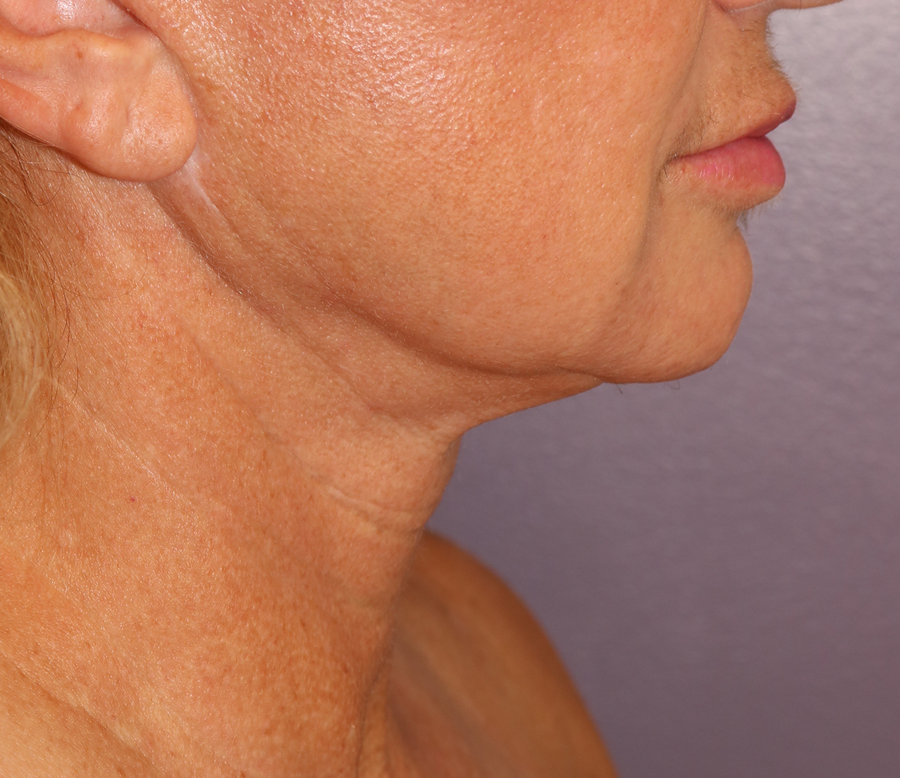 Morpheus8 Before & After Patient #20078