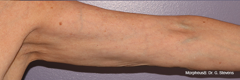 Morpheus8 Before & After Patient #20081