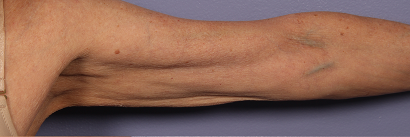 Morpheus8 Before & After Patient #20081