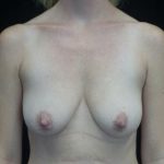 Breast Lift Before & After Patient #20058