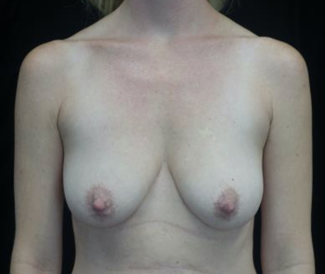 Breast Lift Before & After Patient #20058