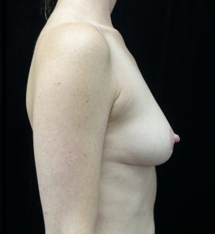 Breast Lift Before & After Patient #20058