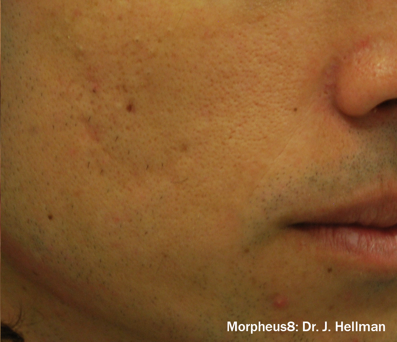 Morpheus8 Before & After Patient #20094
