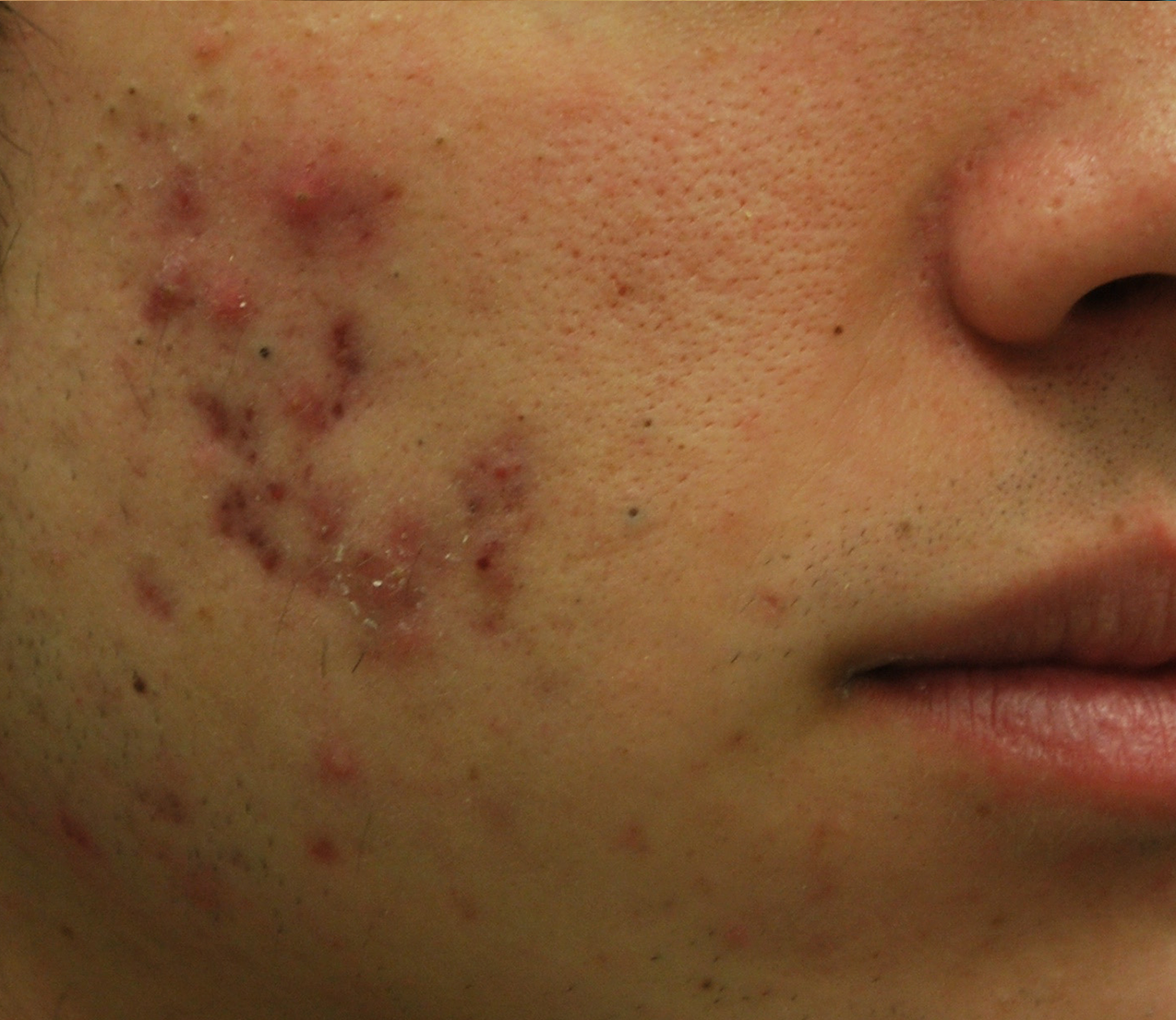Morpheus8 Before & After Patient #20094