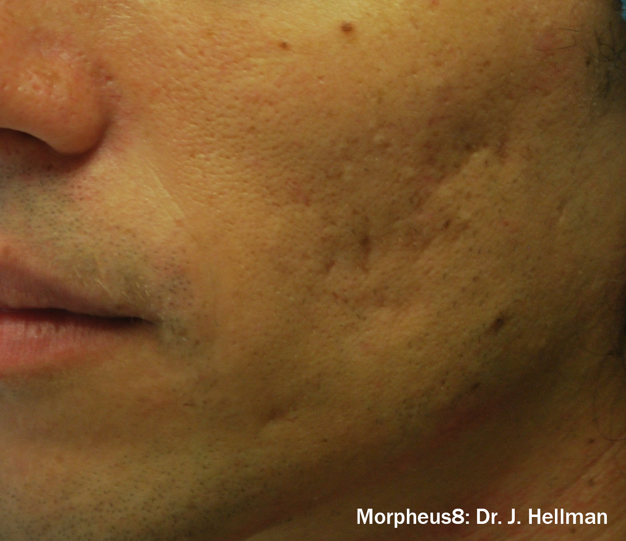Morpheus8 Before & After Patient #20088