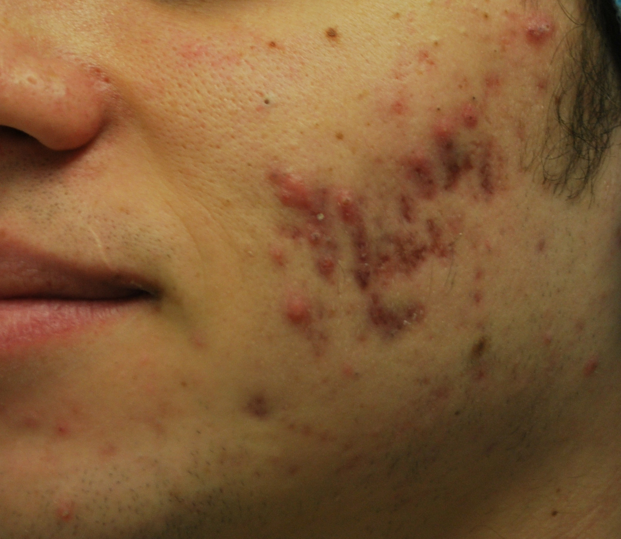 Morpheus8 Before & After Patient #20088