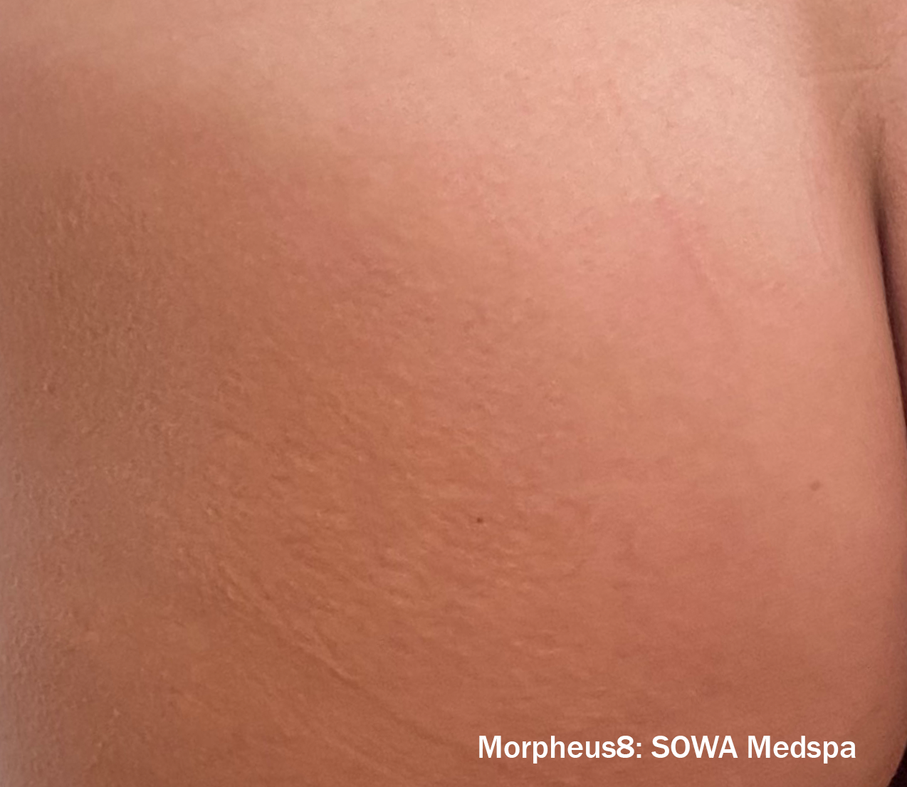 Morpheus8 Before & After Patient #20084