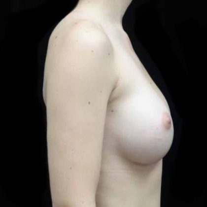 Breast Augmentation (Implants) Before & After Patient #20131