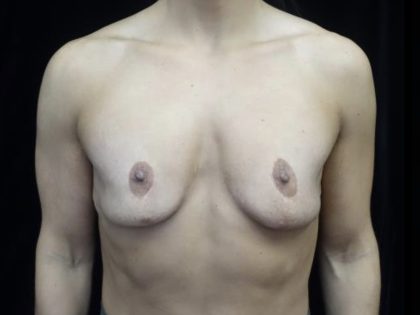Breast Revision Before & After Patient #20072