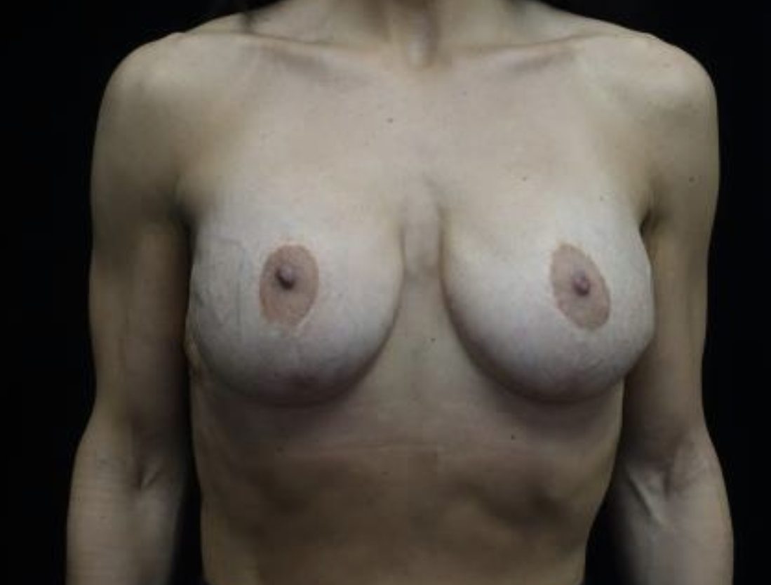 Breast Revision Before & After Patient #20072
