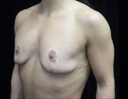 Breast Revision Before & After Patient #20072