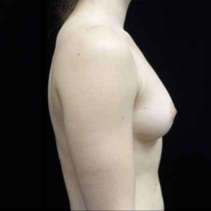 Breast Augmentation (Fat Transfer) Before & After Patient #20040