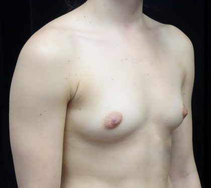 Breast Augmentation (Fat Transfer) Before & After Patient #20040