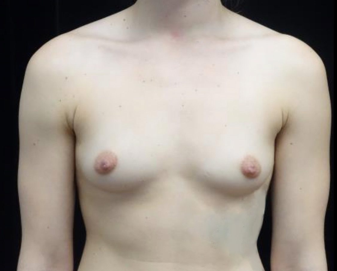 Breast Augmentation (Fat Transfer) Before & After Patient #20040