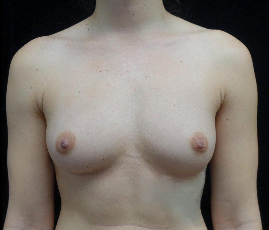 Breast Augmentation (Fat Transfer) Before & After Patient #20040