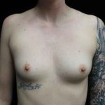 Breast Augmentation (Implants) Before & After Patient #20159