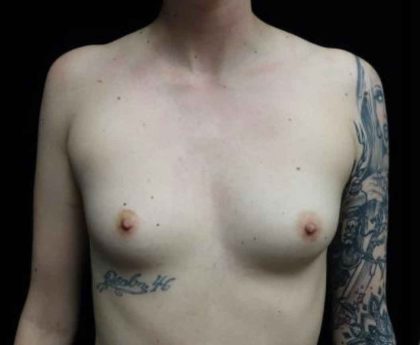 Breast Augmentation (Implants) Before & After Patient #20159