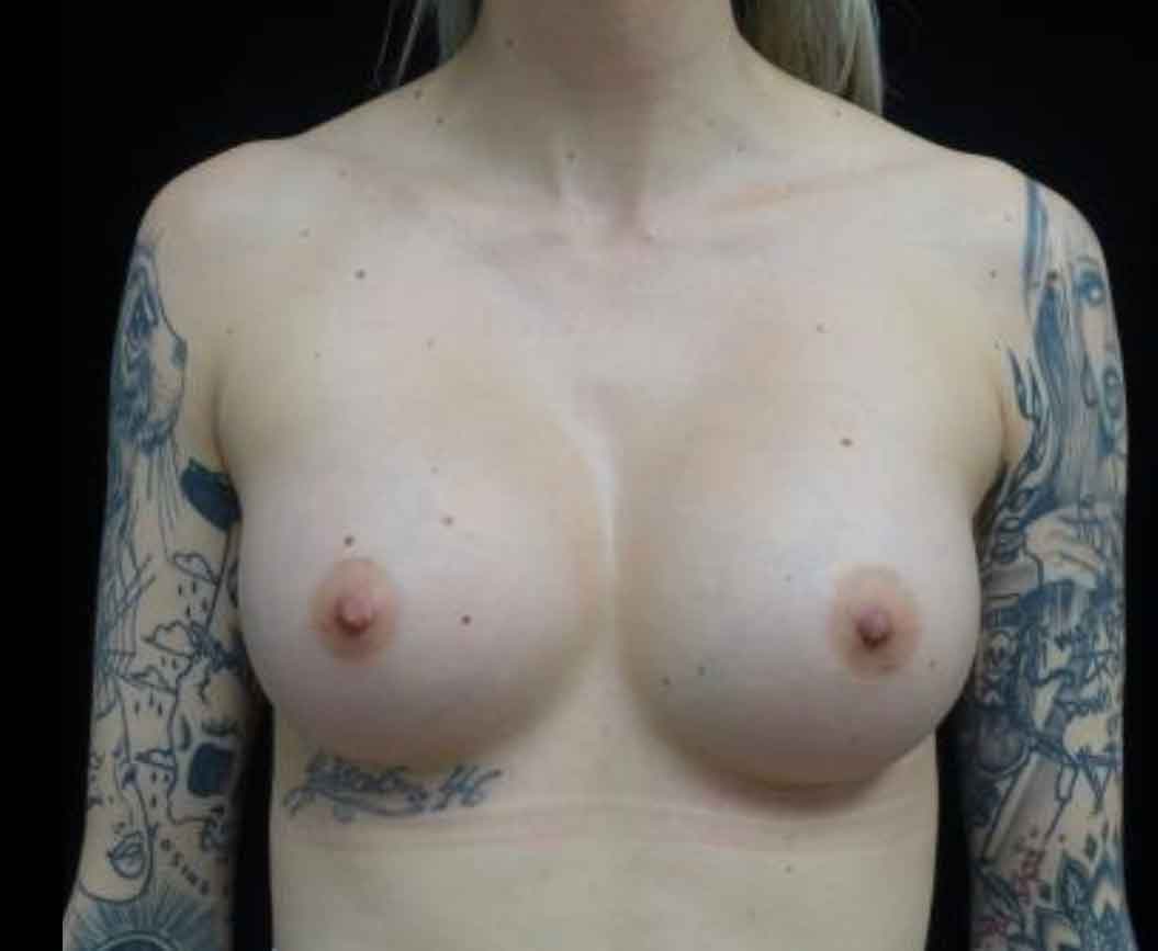 Breast Augmentation (Implants) Before & After Patient #20159